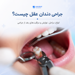 جراحی دندان عقل
