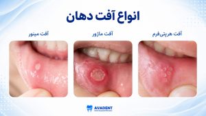 آفت دهان چیست؟