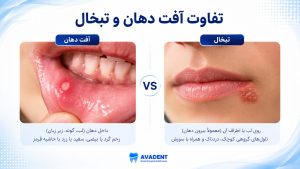 آفت دهان چیست؟