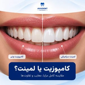 کامپوزیت یا لمینت؟