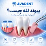پیوند لثه