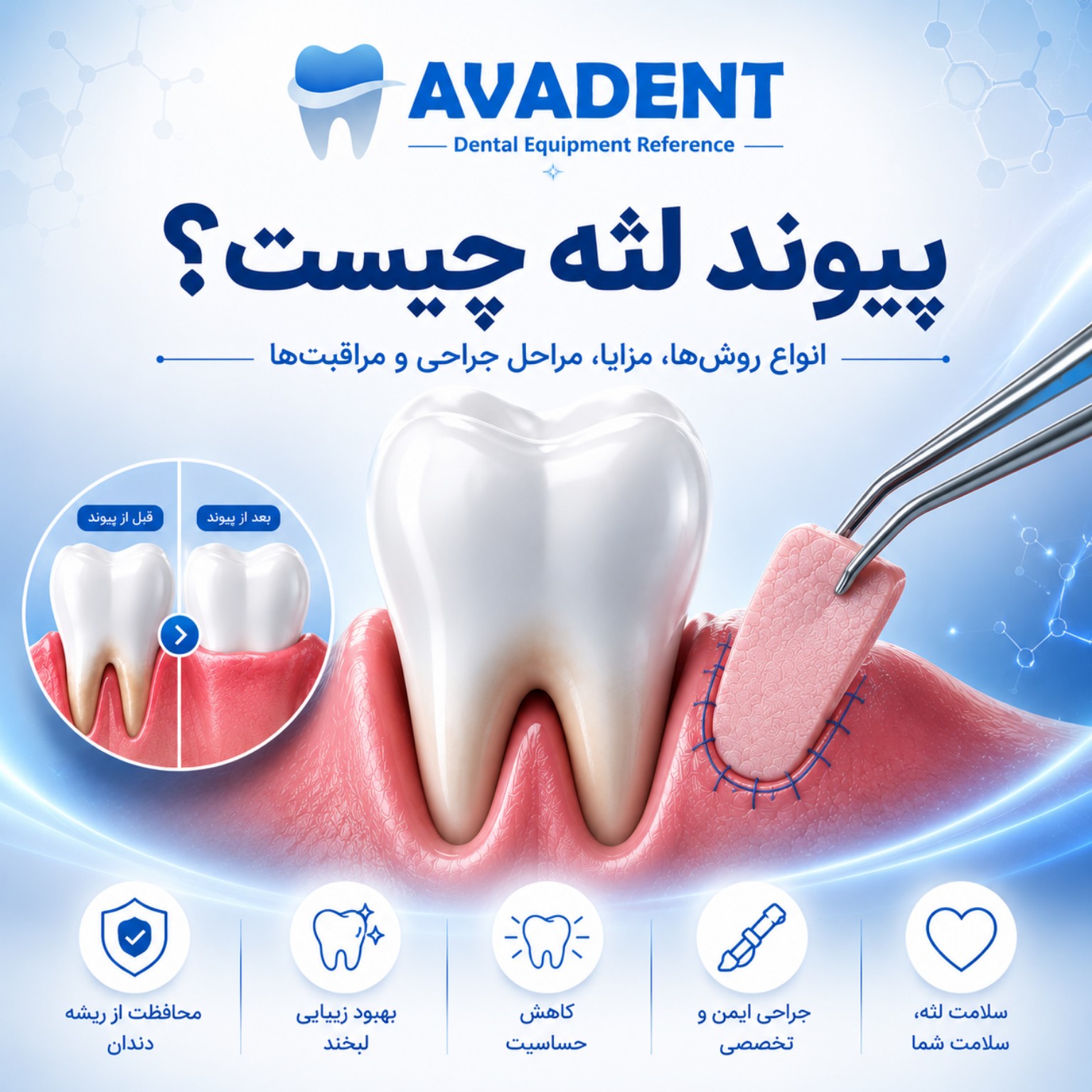 پیوند لثه