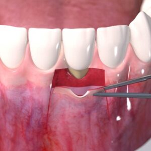 پیوند لثه چیست؟