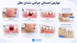 جراحی دندان عقل