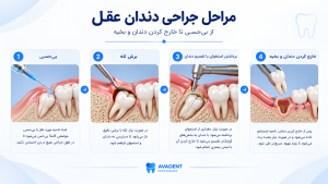 جراحی دندان عقل