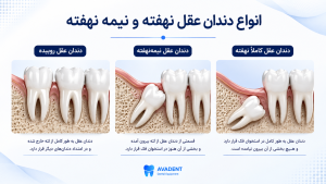 جراحی دندان عقل