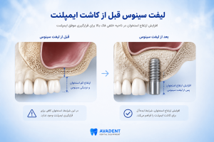 ایمپلنت با وجود پوکی استخوان