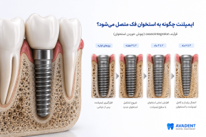 ایمپلنت با وجود پوکی استخوان