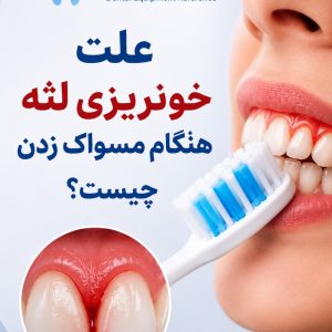 علت خونریزی لثه هنگام مسواک زدن چیست؟