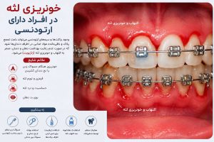 علت خونریزی لثه هنگام مسواک زدن چیست؟