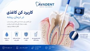 کن کاغذی دندانپزشکی
